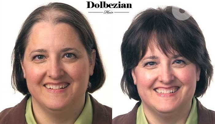 حل جميع مشاكل الصلع والشعر الخفيف للرجال والنساء 3