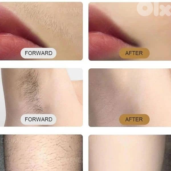 soprano titanium laser hair removal 4