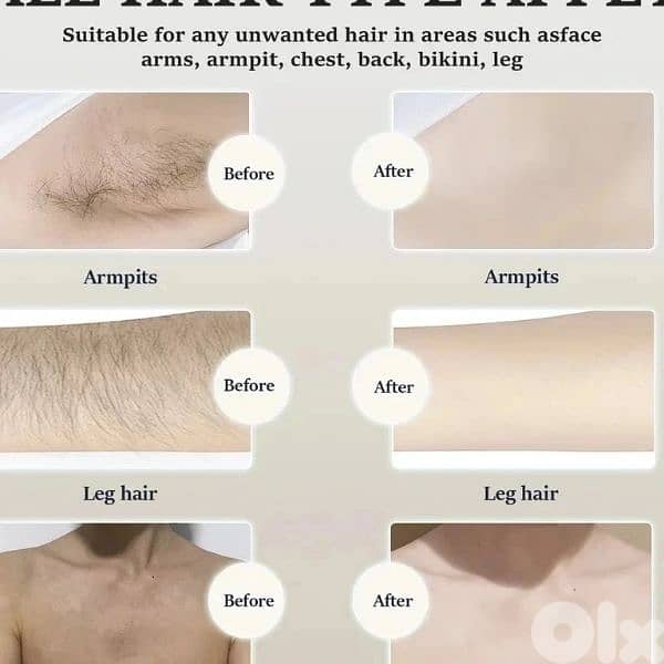 soprano titanium laser hair removal 5
