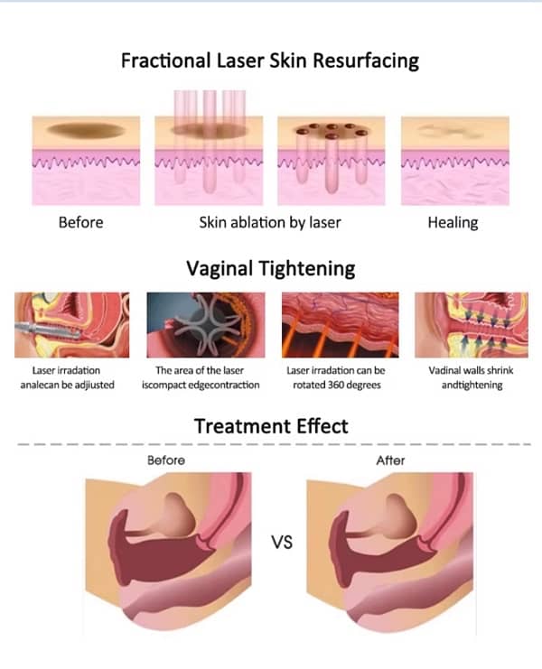 Fractional CO2 Laser Machine 2025 9