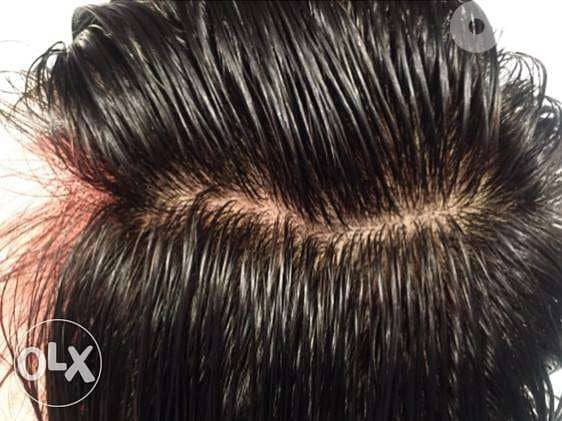 حل جميع مشاكل الصلع والشعر الخفيف للرجال والنساء 7